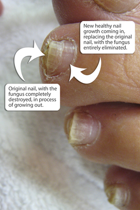 Fresh Nail Growth After Toenail Fungus Treatment