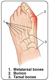 Treat Bunion Deformity In Spring TX