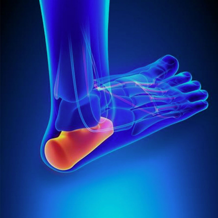 heel pain