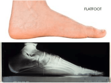 Flat feet: What are they and can they be fixed?