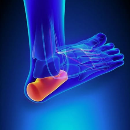 Plantar Fasciitis – Symptoms and Risk Factors