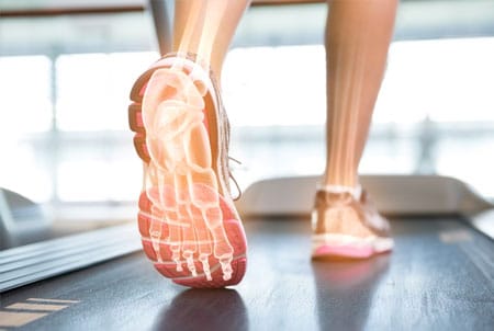 Plantar Fasciitis – Treatment Objectives